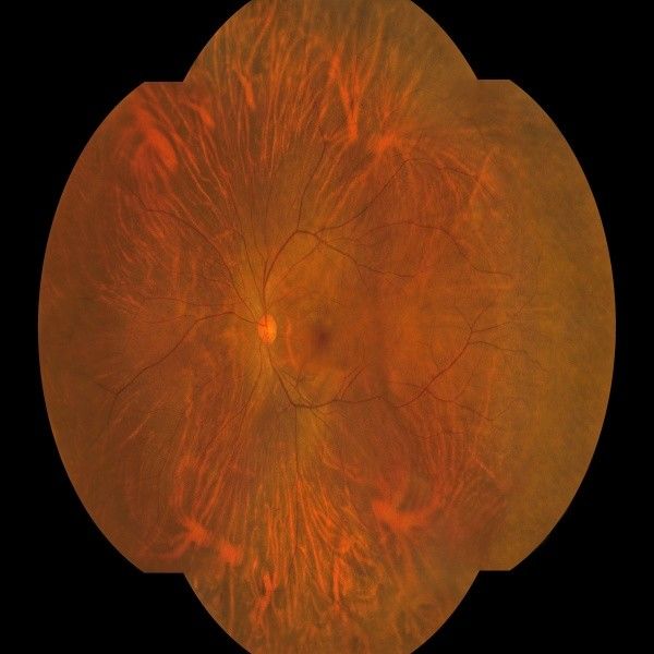 176 graden Wide Field Fundus Camera met AI Intelligent System en One Key Operation voor niet-Mydriatic Single True Color Imaging
